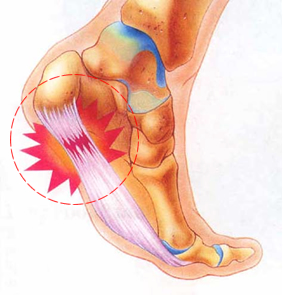 plantar fasciitis